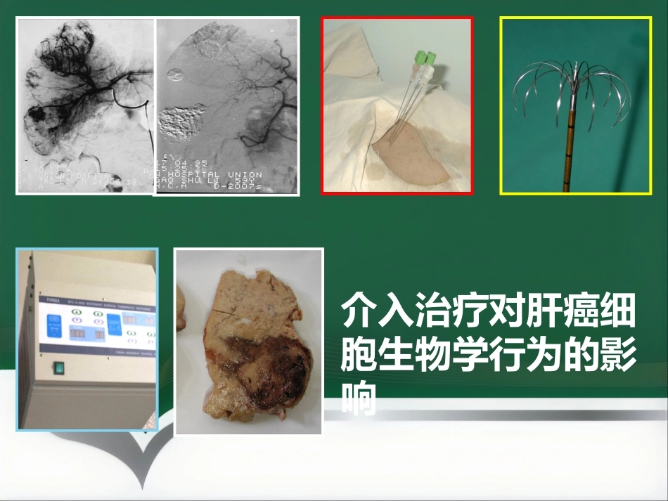 肝癌的靶向性介入治疗_第2页