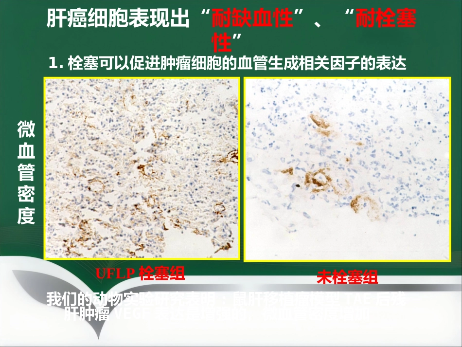 肝癌的靶向性介入治疗_第3页