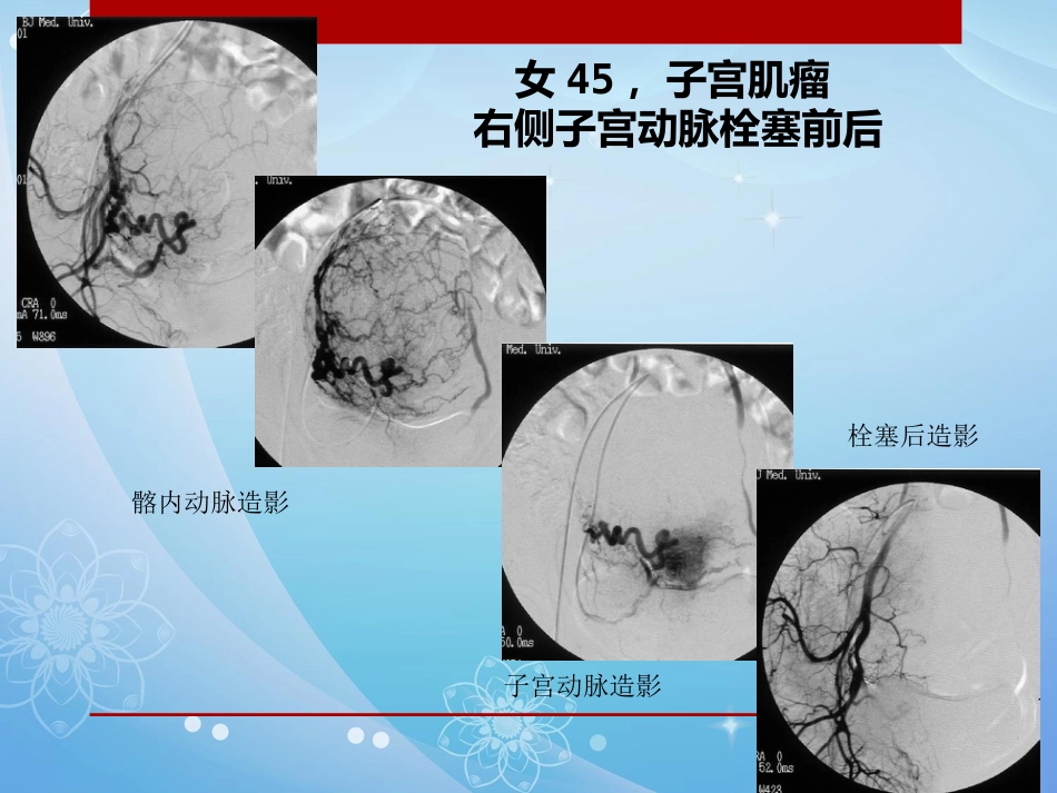 妇科肿瘤的介入治疗PPT课件_第10页