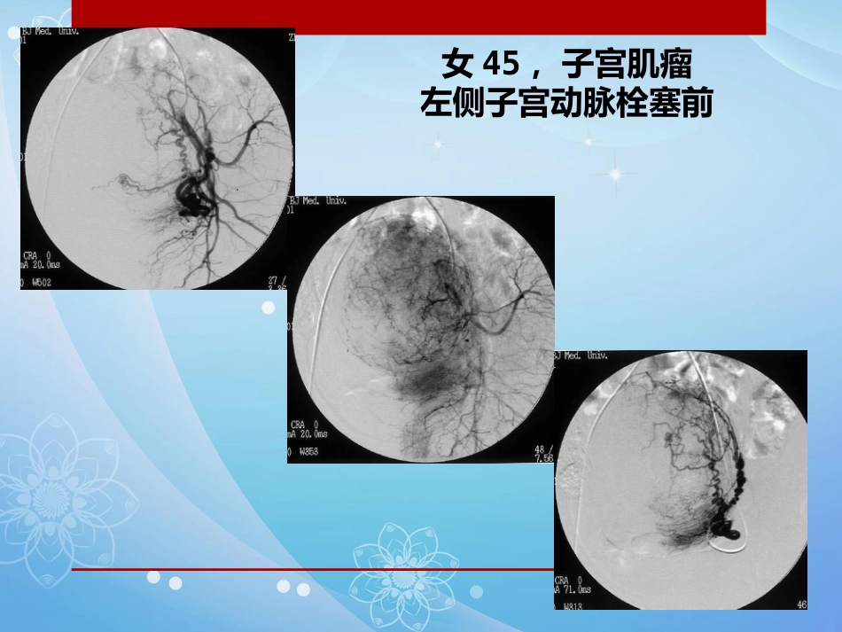 妇科肿瘤的介入治疗PPT课件_第11页
