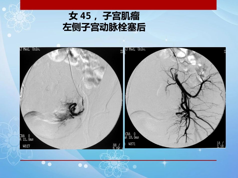 妇科肿瘤的介入治疗PPT课件_第12页