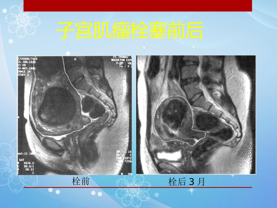 妇科肿瘤的介入治疗PPT课件_第13页
