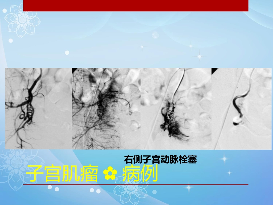 妇科肿瘤的介入治疗PPT课件_第15页