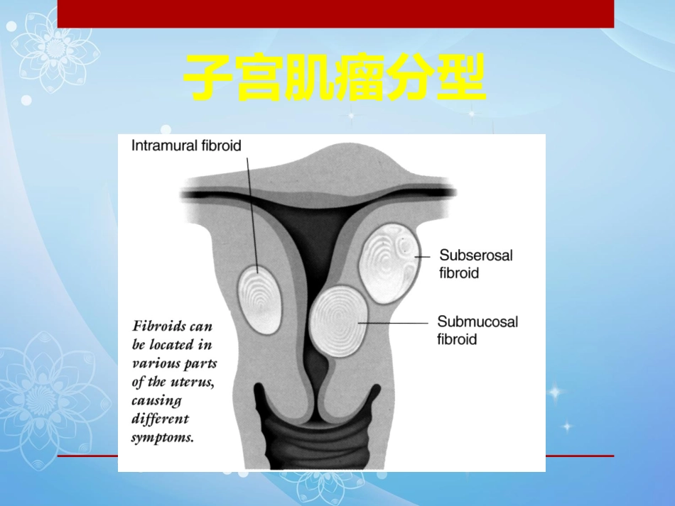 妇科肿瘤的介入治疗PPT课件_第6页