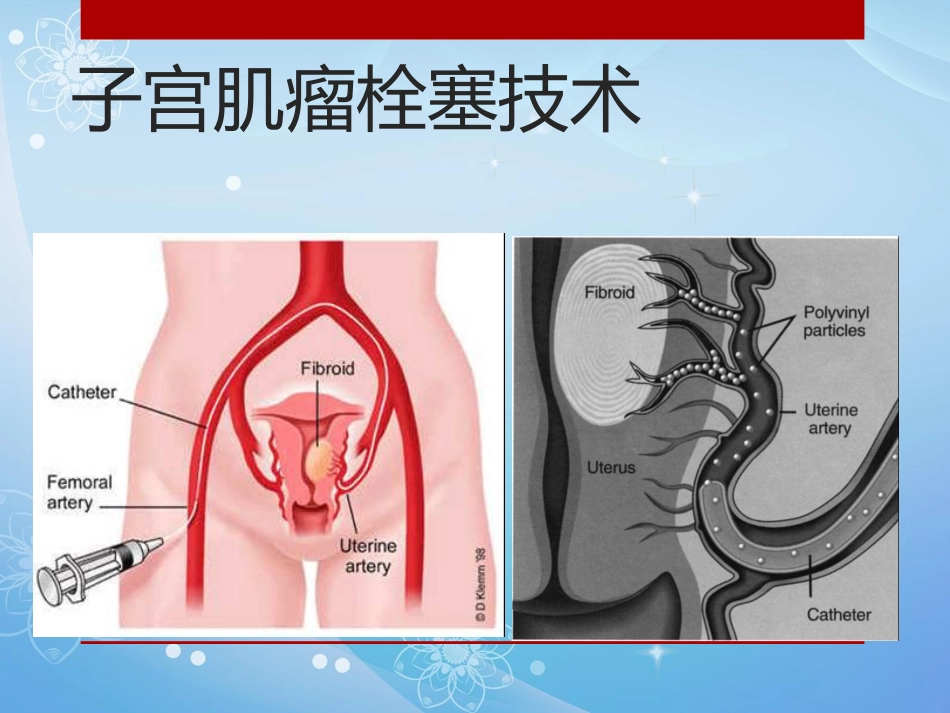 妇科肿瘤的介入治疗PPT课件_第9页