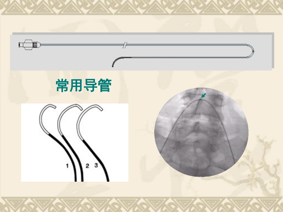 妇产科大出血的介入治疗ppt课件_第15页