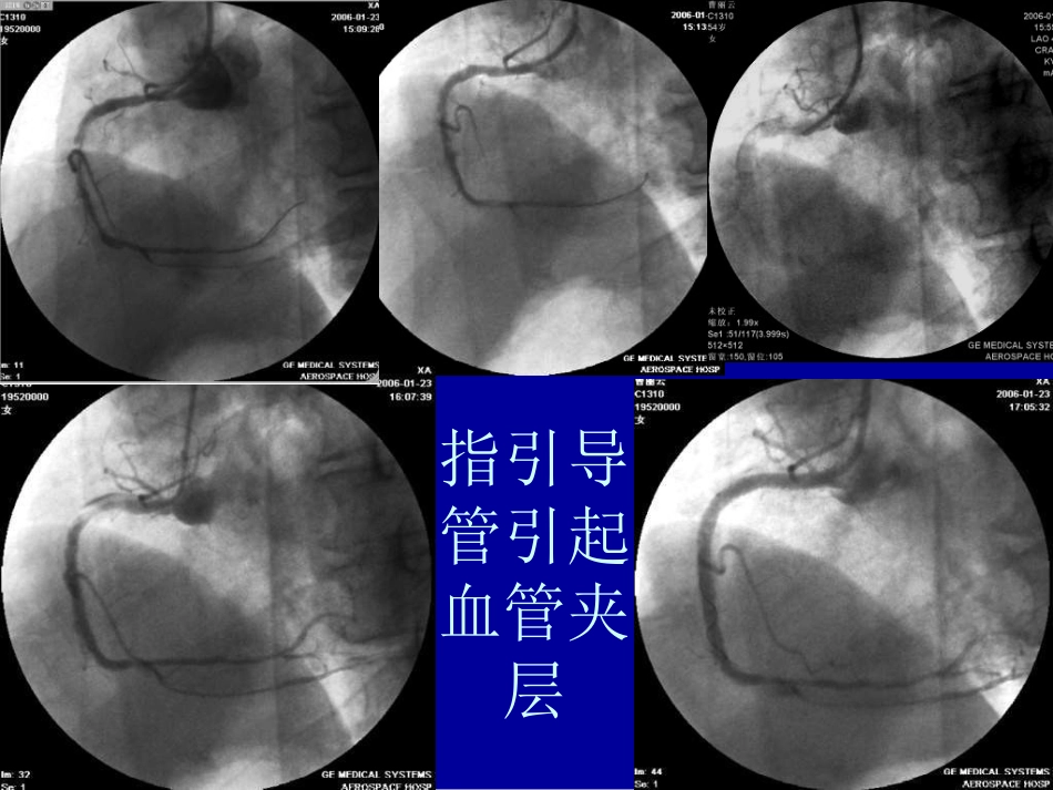 复杂冠状动脉介入治疗相关并发症的识别与处理_第12页