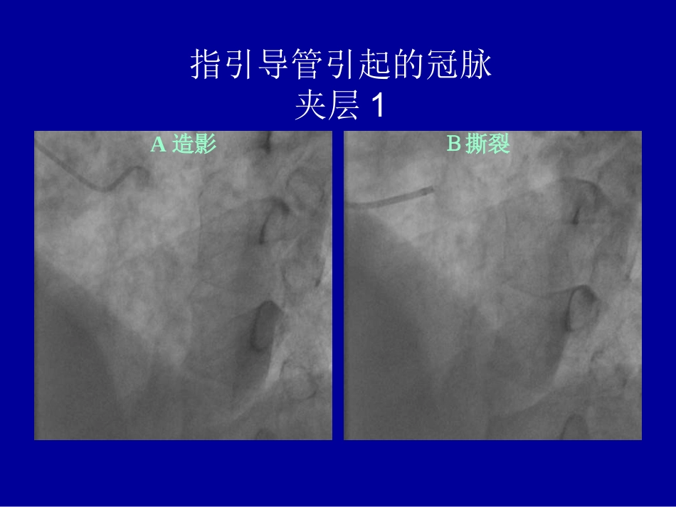 复杂冠状动脉介入治疗相关并发症的识别与处理_第13页
