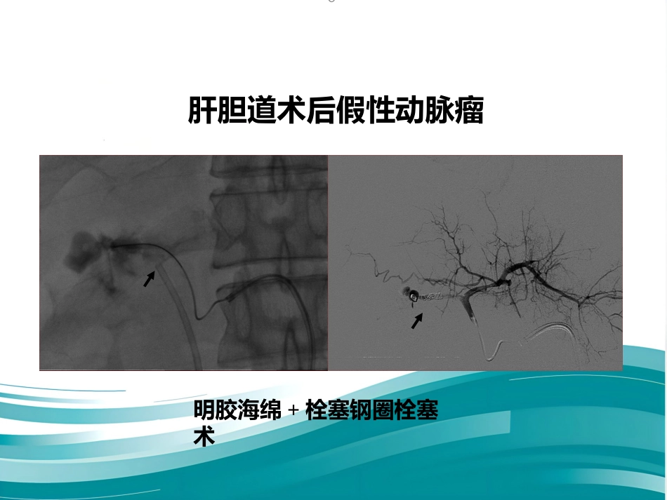 腹部脏器假性动脉瘤介入治疗策略_第10页