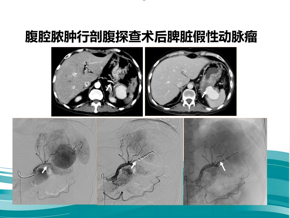 腹部脏器假性动脉瘤介入治疗策略_第11页