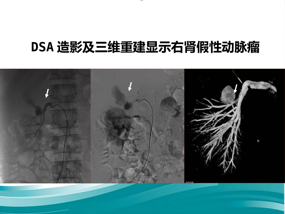 腹部脏器假性动脉瘤介入治疗策略_第13页