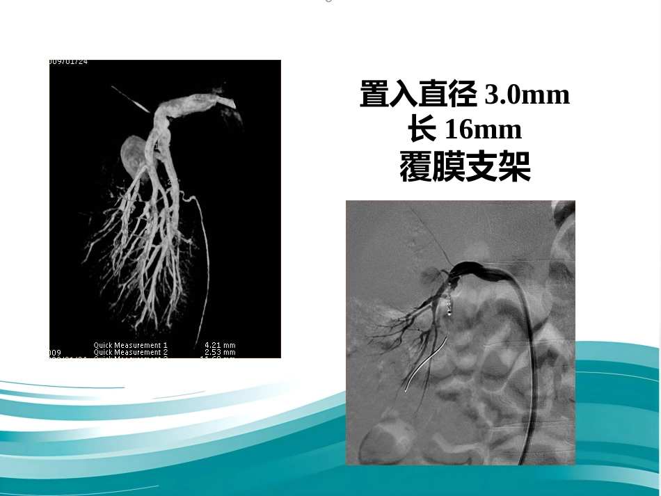腹部脏器假性动脉瘤介入治疗策略_第14页