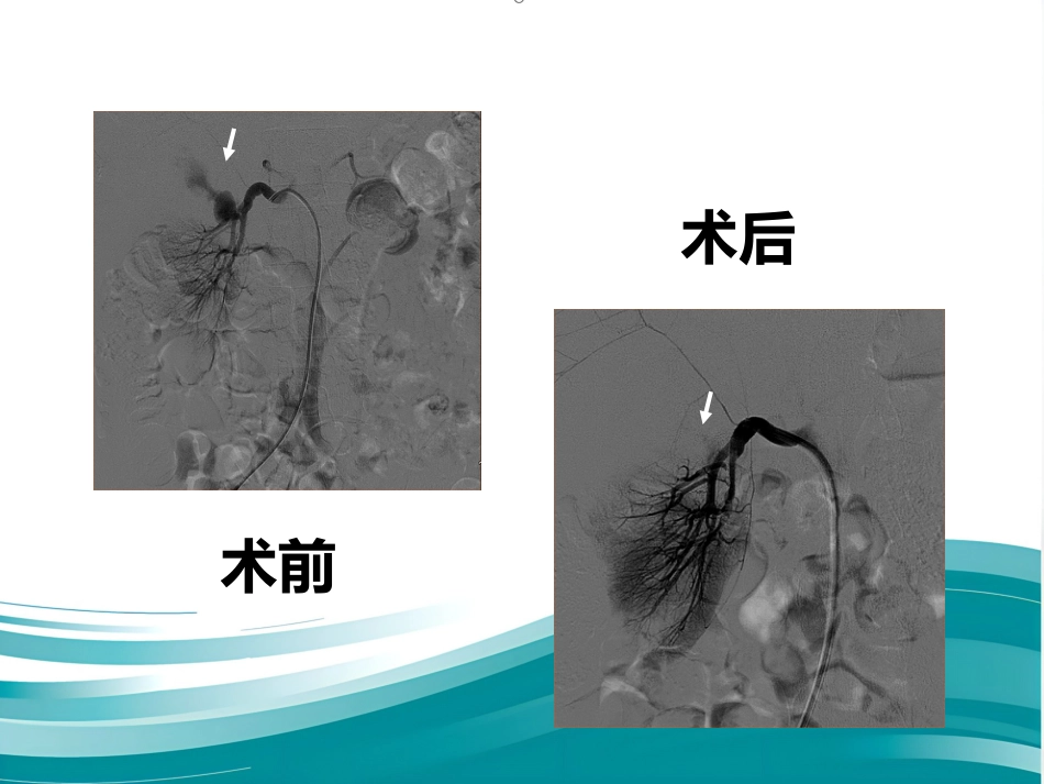 腹部脏器假性动脉瘤介入治疗策略_第15页