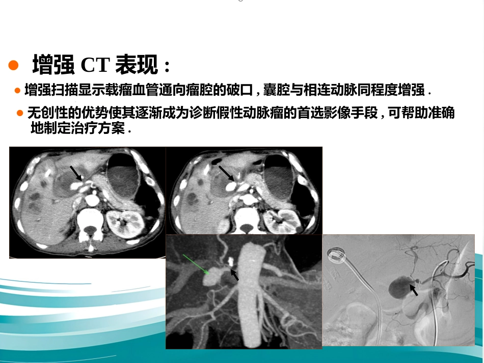 腹部脏器假性动脉瘤介入治疗策略_第5页