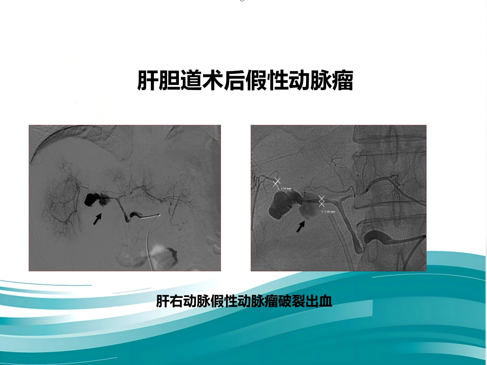 腹部脏器假性动脉瘤介入治疗策略_第9页