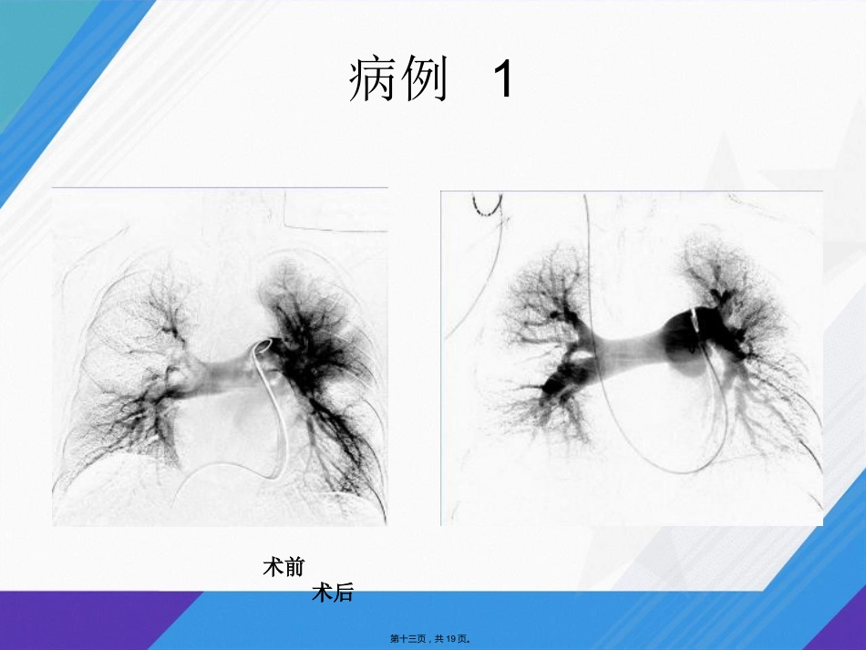 肺栓塞介入治疗讲课_第12页