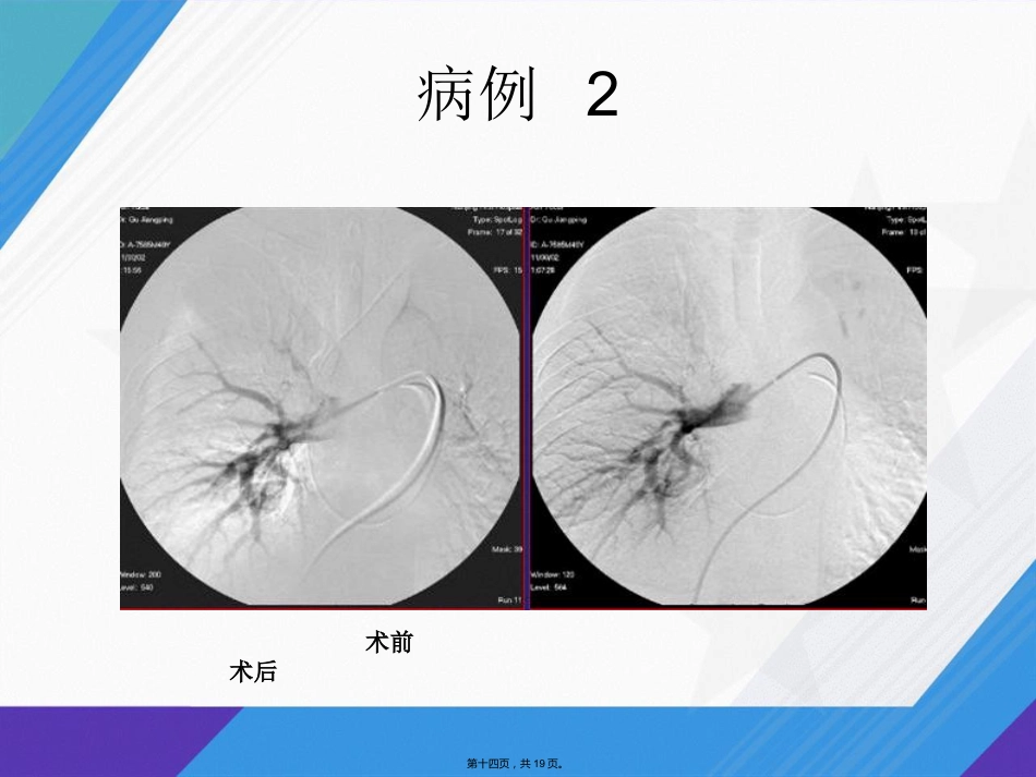 肺栓塞介入治疗讲课_第13页
