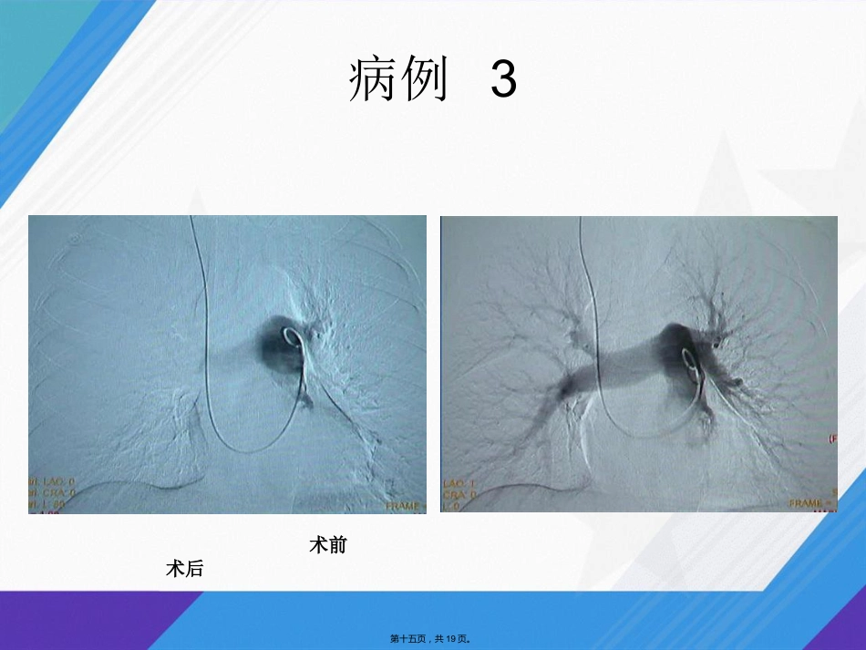 肺栓塞介入治疗讲课_第14页