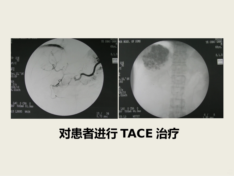 肝癌介入治疗PPT课件_第11页