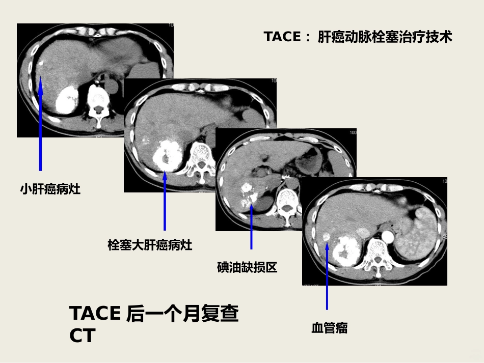肝癌介入治疗PPT课件_第12页