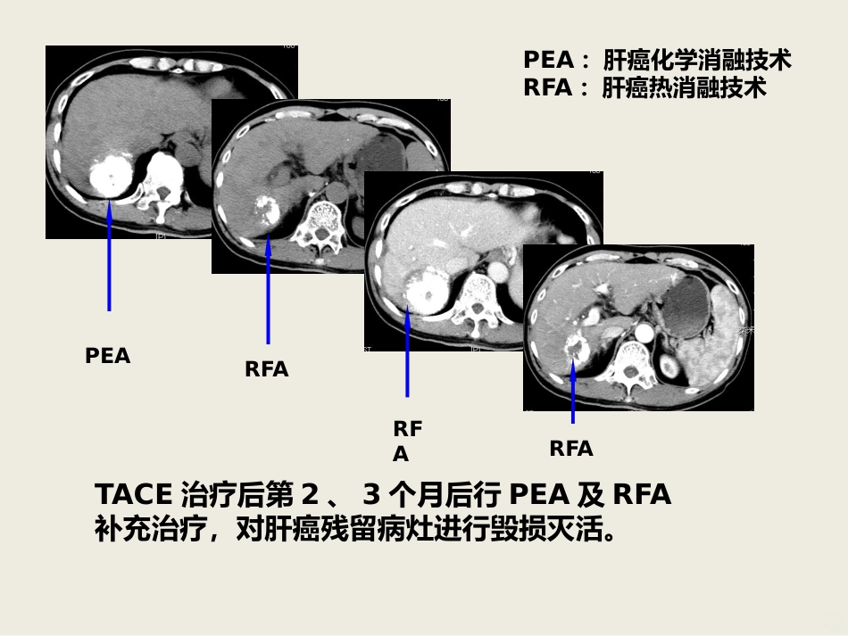 肝癌介入治疗PPT课件_第13页