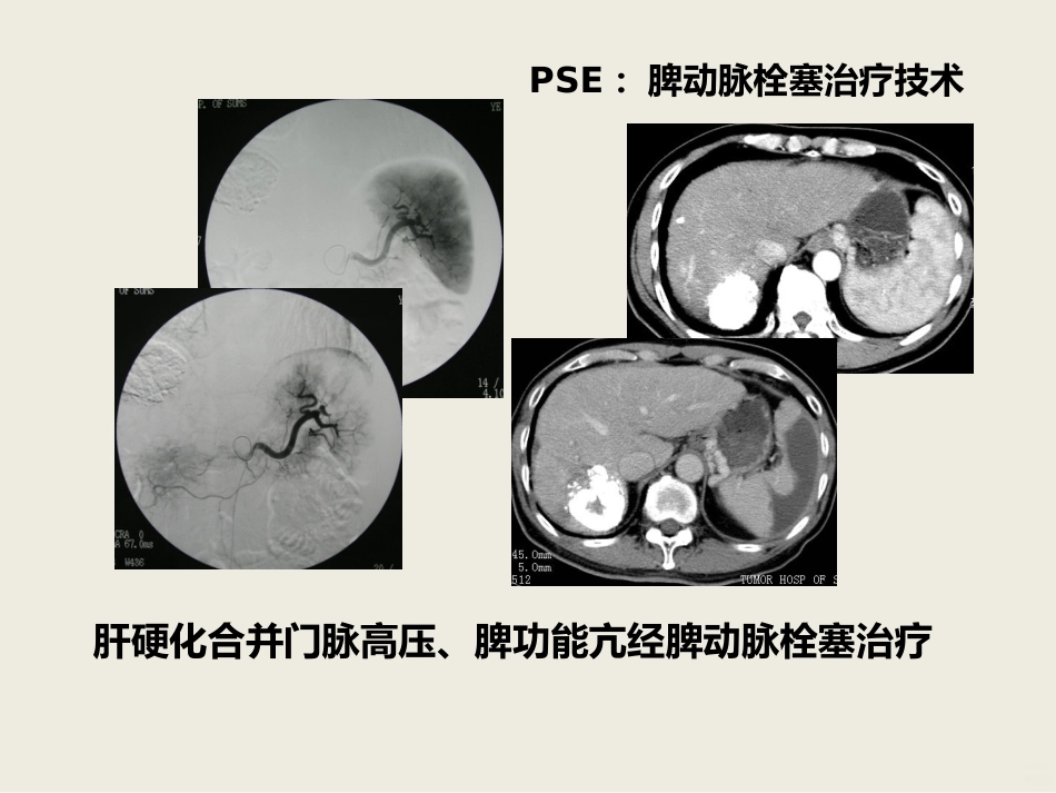 肝癌介入治疗PPT课件_第14页