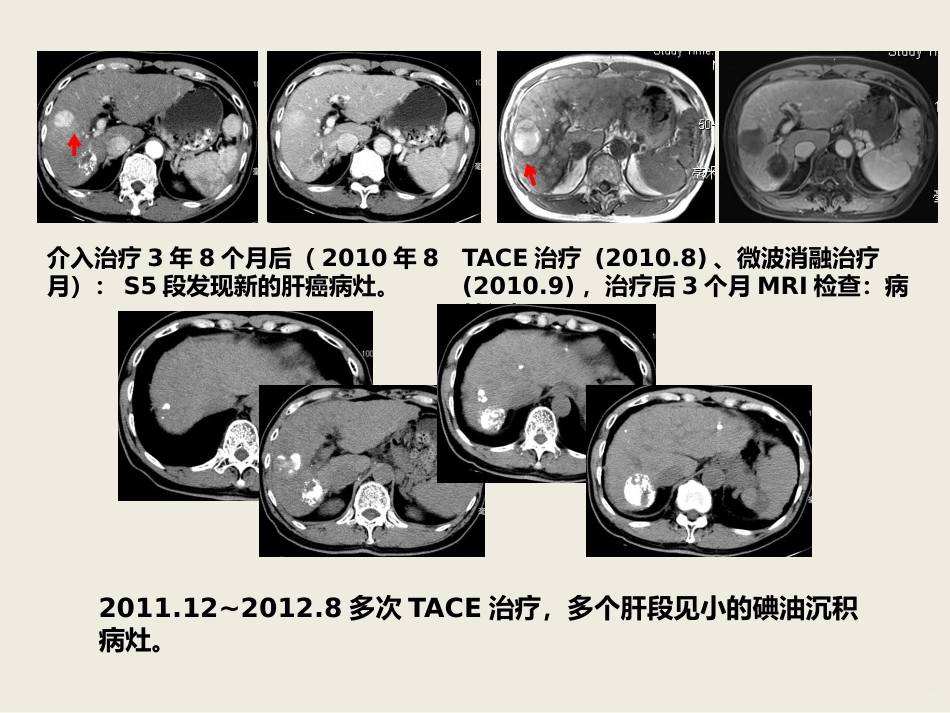 肝癌介入治疗PPT课件_第15页