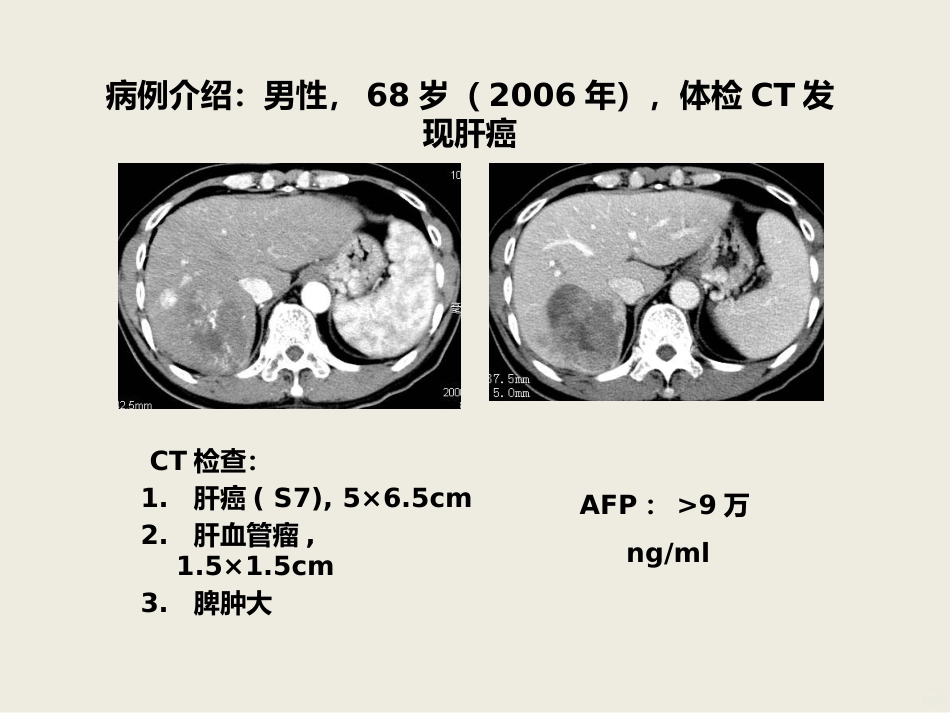 肝癌介入治疗PPT课件_第2页