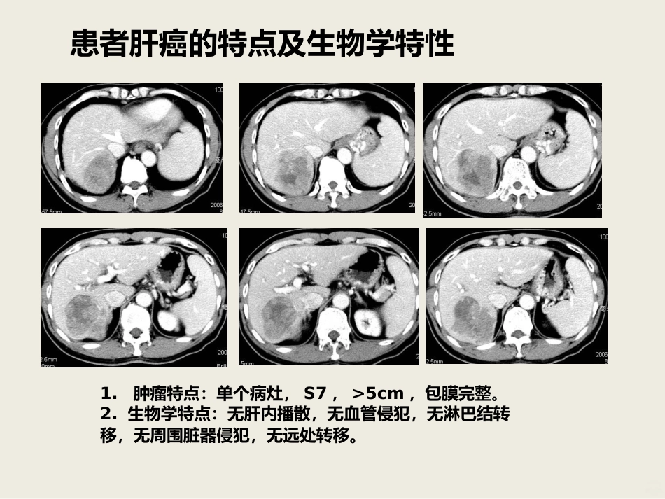 肝癌介入治疗PPT课件_第3页