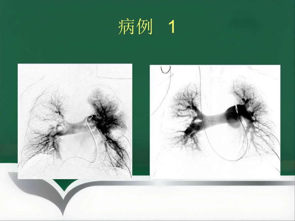 肺栓塞 介入治疗讲解_第12页
