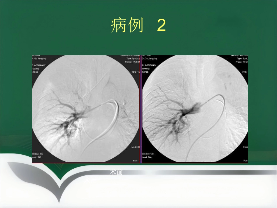 肺栓塞 介入治疗讲解_第13页