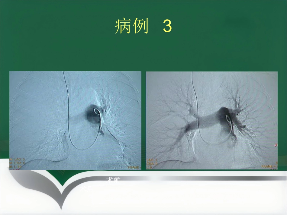 肺栓塞 介入治疗讲解_第14页