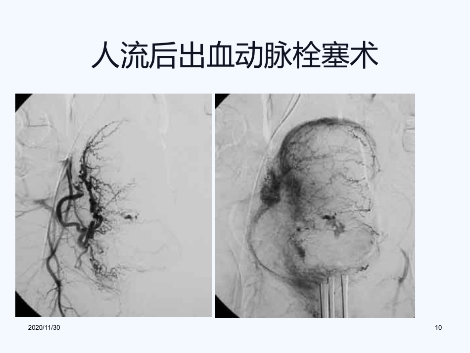 妇产科血管内介入治疗(1)_第10页