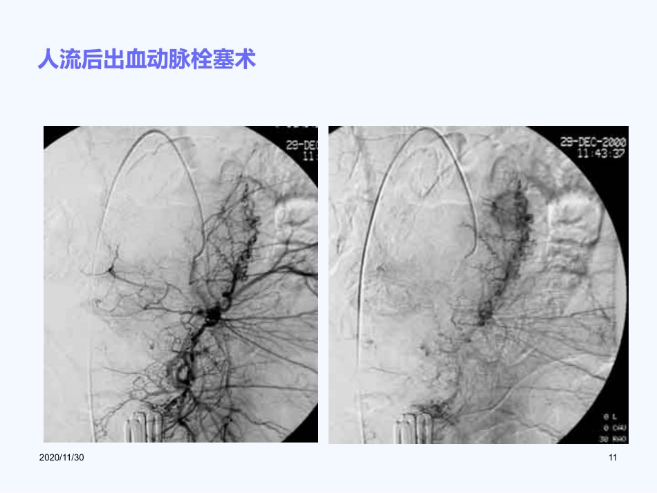 妇产科血管内介入治疗(1)_第11页
