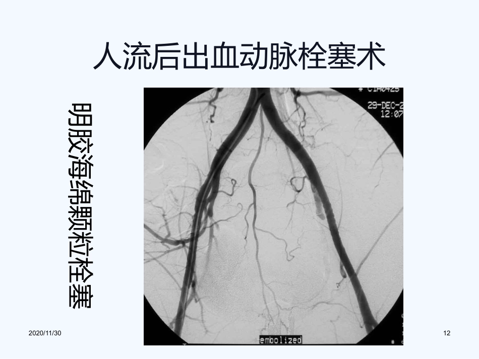 妇产科血管内介入治疗(1)_第12页