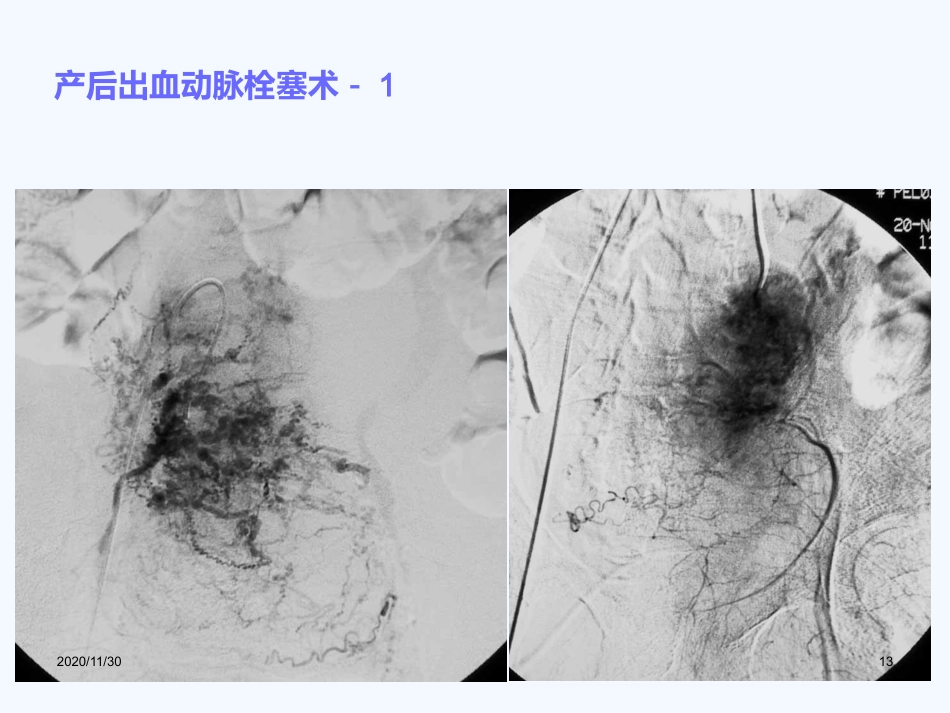 妇产科血管内介入治疗(1)_第13页