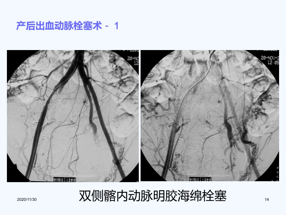 妇产科血管内介入治疗(1)_第14页