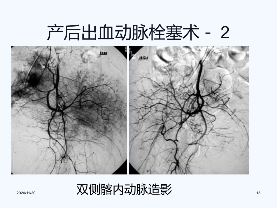 妇产科血管内介入治疗(1)_第15页