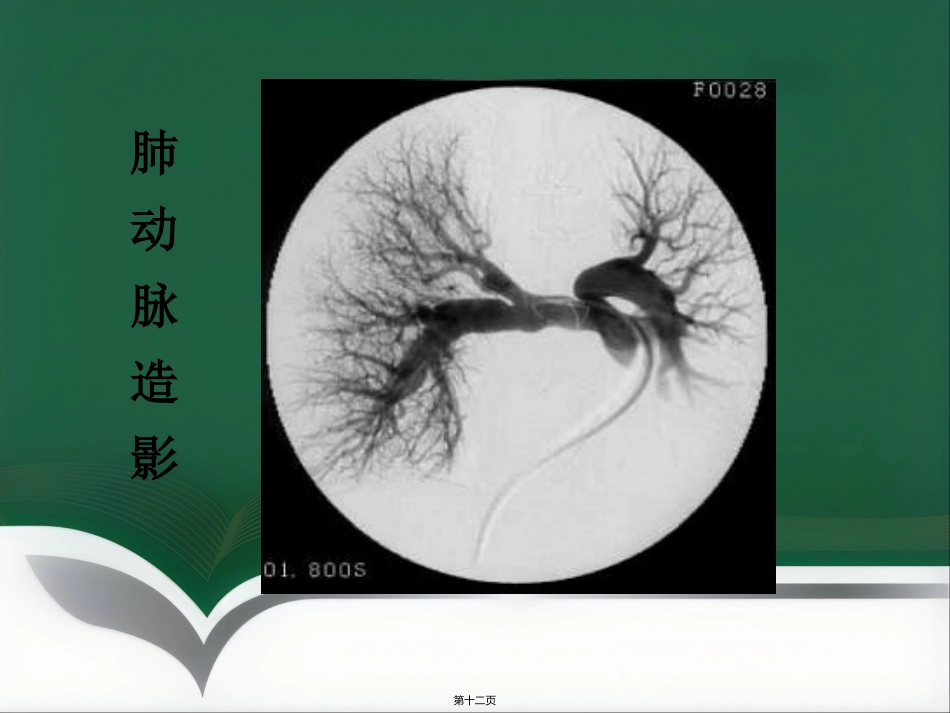 肺栓塞介入治疗(1)_第12页