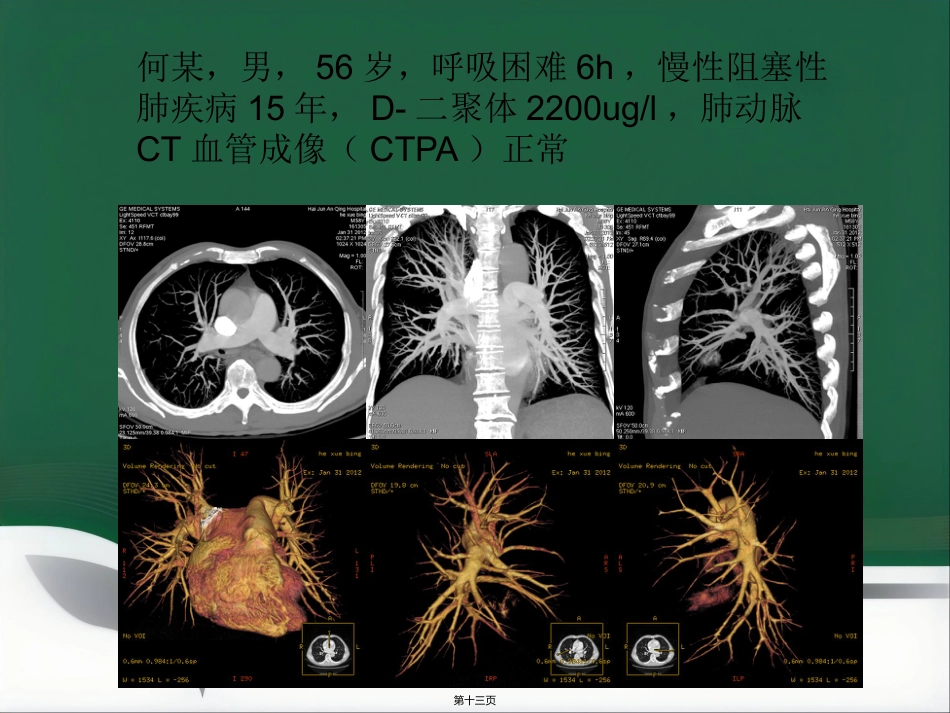 肺栓塞介入治疗(1)_第13页