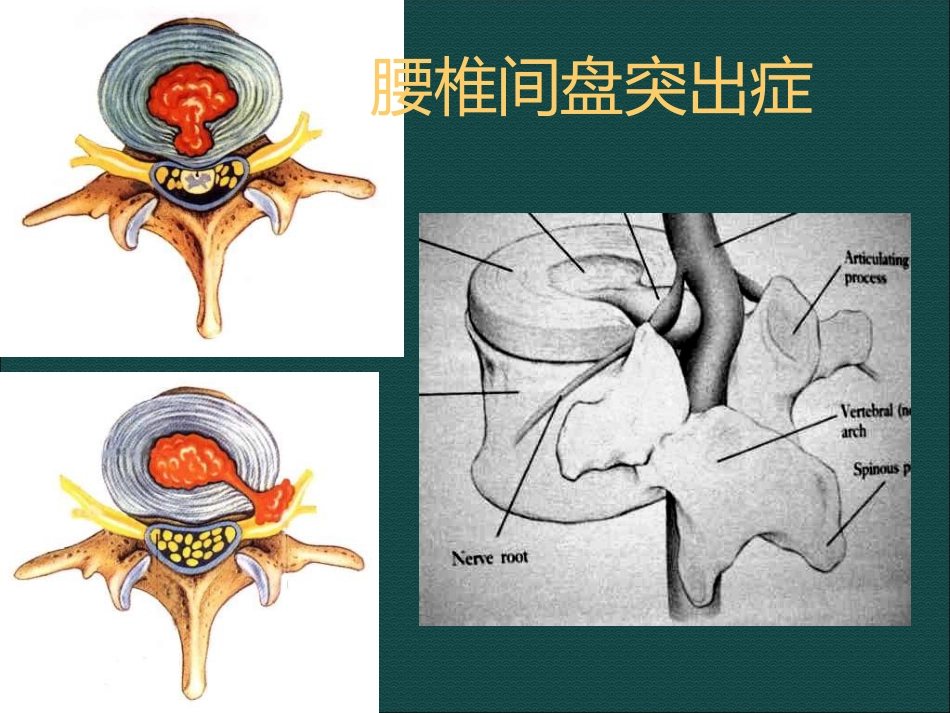 常见脊柱骨骼系统病变影像诊断_第10页