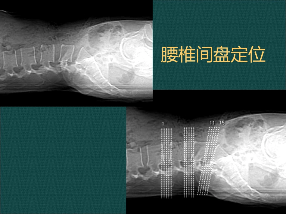 常见脊柱骨骼系统病变影像诊断_第13页