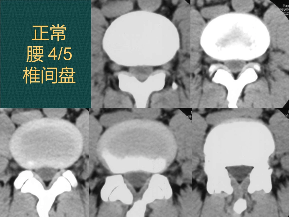 常见脊柱骨骼系统病变影像诊断_第14页