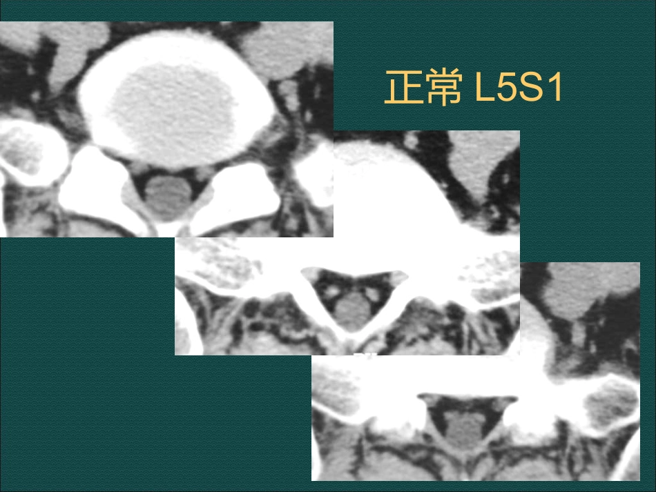 常见脊柱骨骼系统病变影像诊断_第15页