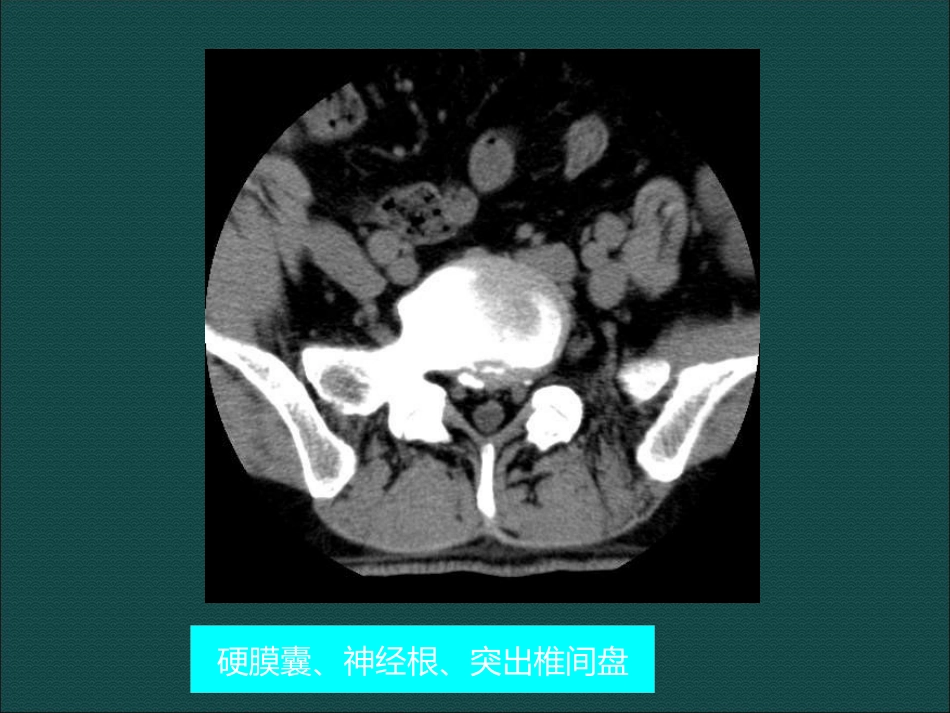 常见脊柱骨骼系统病变影像诊断_第6页