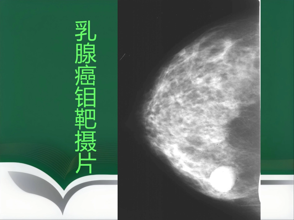 d乳腺疾病的影像诊断_第14页