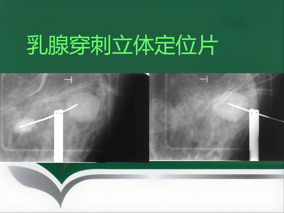 d乳腺疾病的影像诊断_第15页