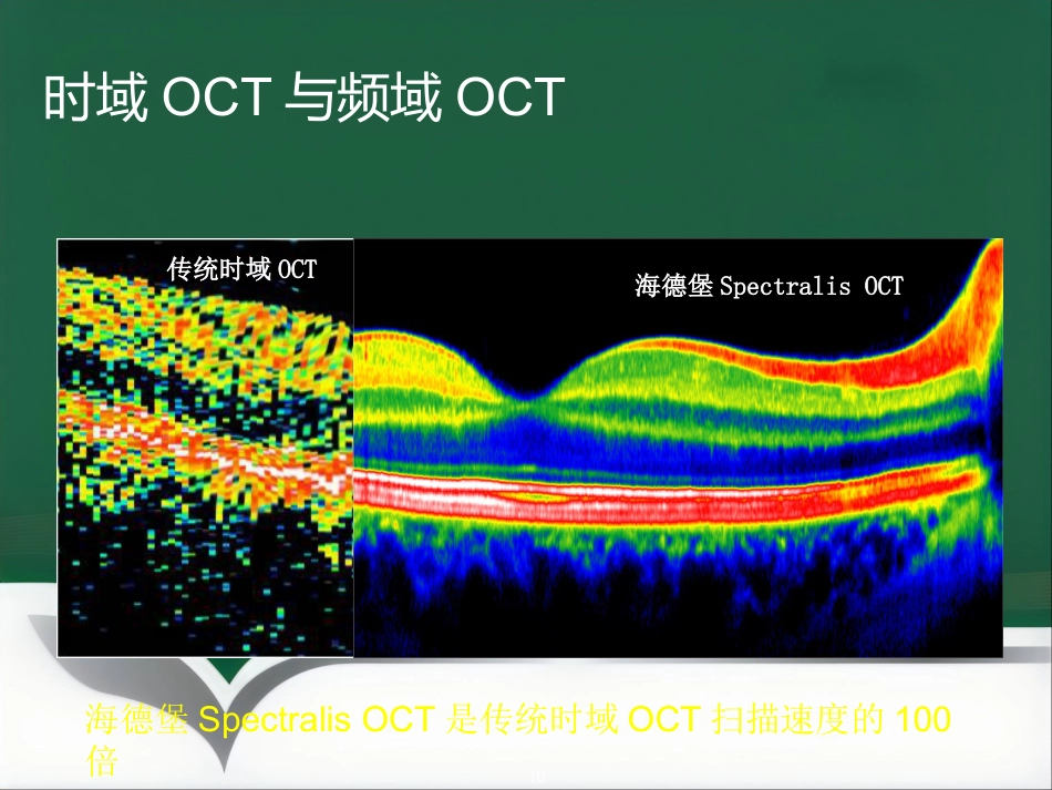 OCT影像技术的临床应用_第10页