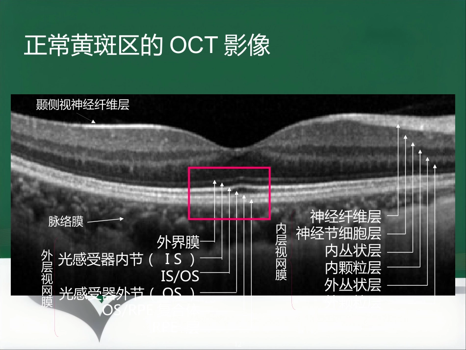 OCT影像技术的临床应用_第12页
