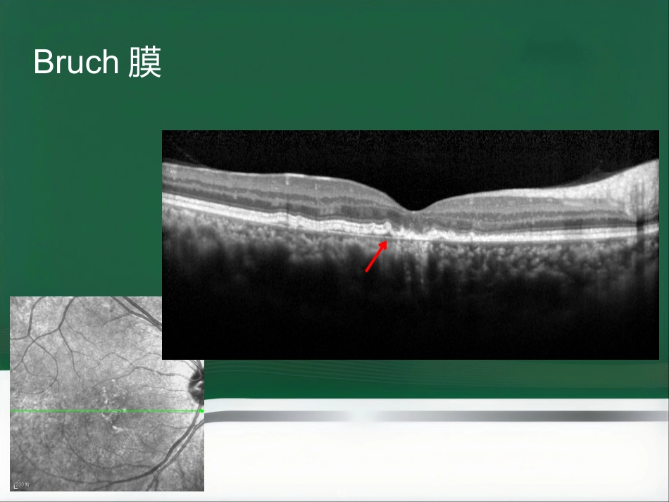 OCT影像技术的临床应用_第13页